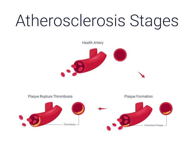 Atherosclerosis diseases stage anatomy diagram vector illustration