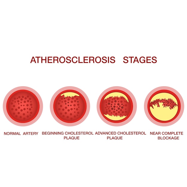 Atherosclerosis stagesThe accumulation of cholesterol in the blood vessels Atherosclerosis