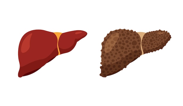 atty livers disease. Unhealthy sick liver and strong healthy liver. Digestive system anatomy. Fibrosis and cirrhosis icon isolated on white background.