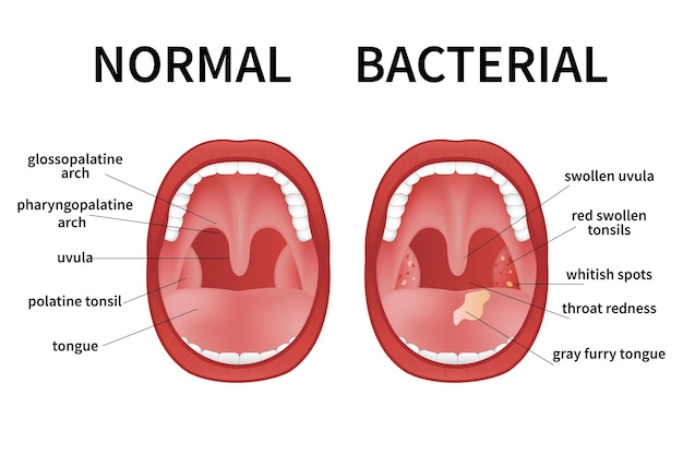 Bacterial and viral tonsillitis Angina pharyngitis and tonsillitis Tonsil infection Open Mouth