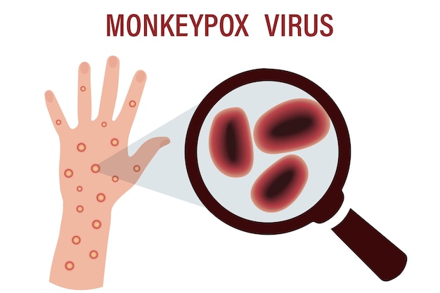 A banner with the monkey pox virus on the skin Pandemic design of the outbreak of the monkey pox