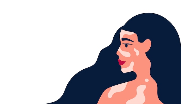 Beautiful female with vitiligo pigment skin and has a lot of blue hair vector illustration