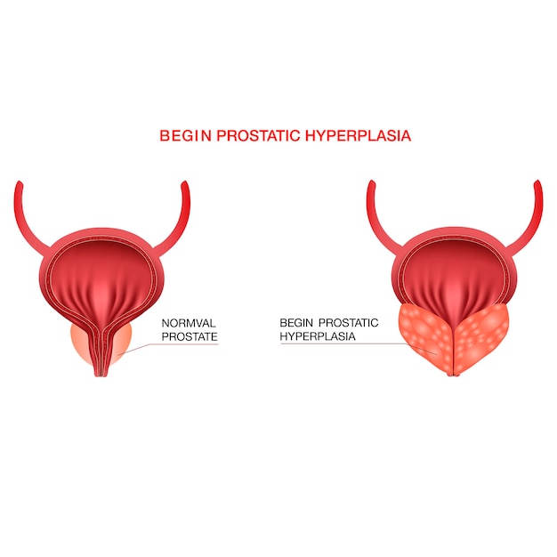 Benign prostatic hyperplasiaEditable vector illustration in realistic style