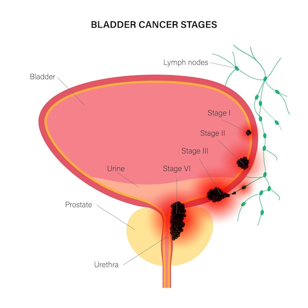 Bladder cancer stages