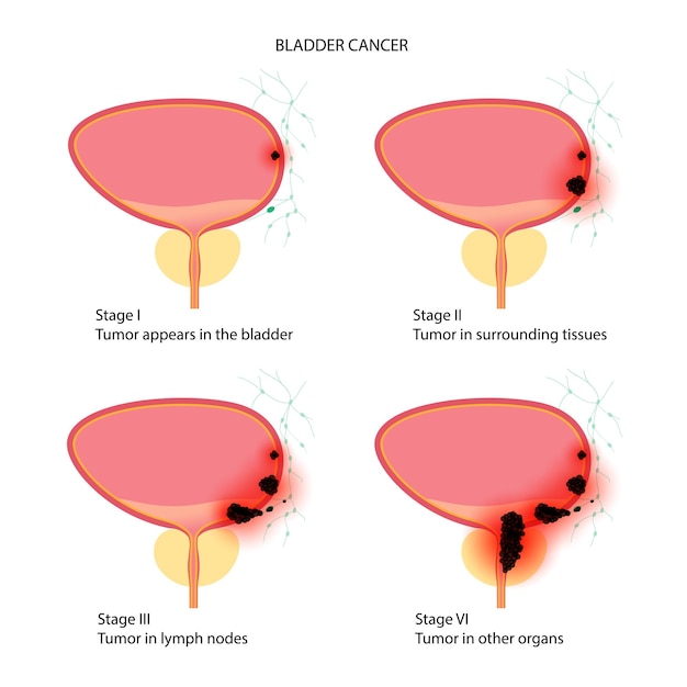 Bladder cancer stages