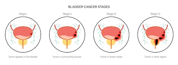 Bladder cancer stages