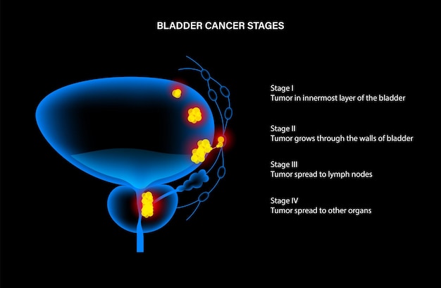 Vector bladder cancer stages