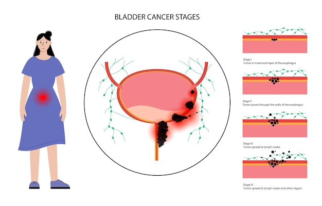 Bladder cancer stages