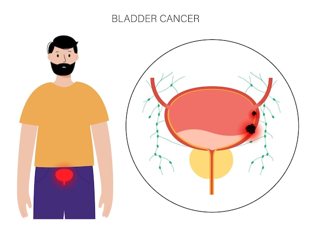 Bladder cancer stages