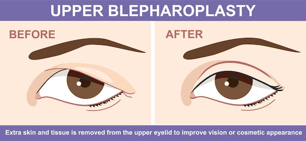 Blepharoplasty of eyelid before and after