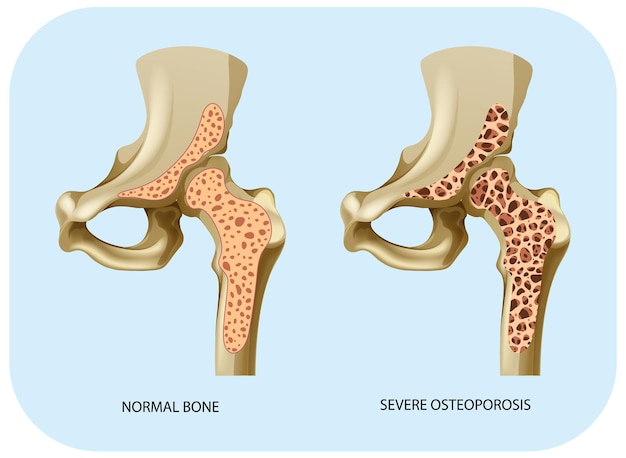 Bone Density and Osteoporosis Vector