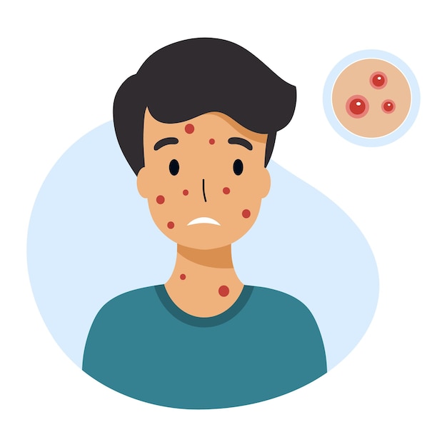 Vector boy with chickenpox symptoms. skin rashes and pimples. vector character in  flat style.