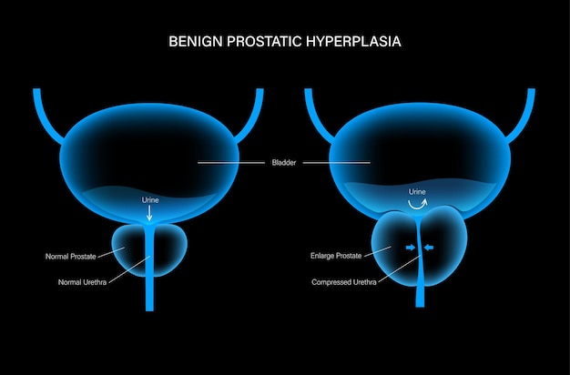 BPH info concept