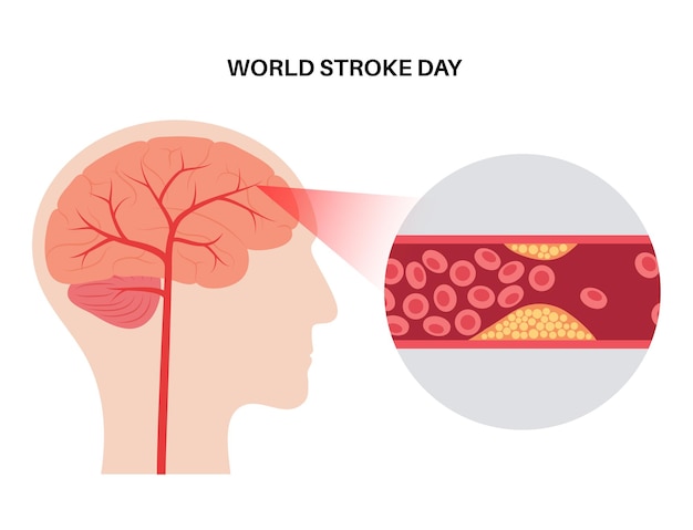 Brain stroke ishemic