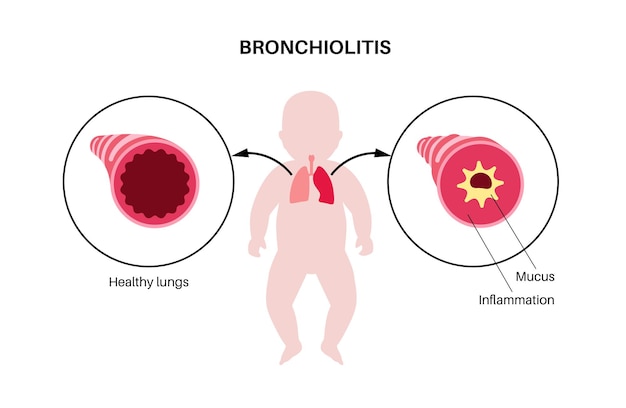 Vector bronchiolitis lung disease