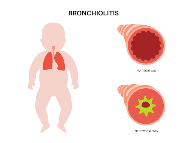 Vector bronchiolitis lung disease