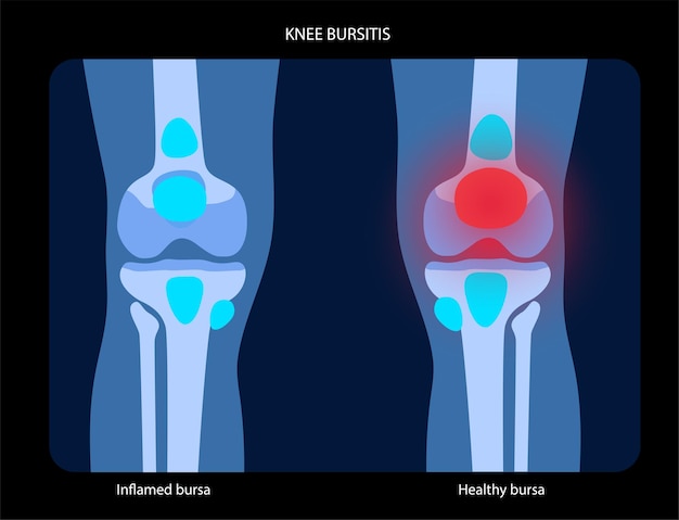 Bursitis inflammation concept