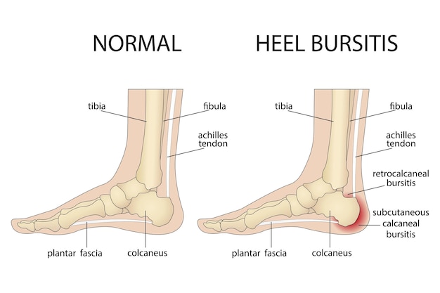 Calcaneal bursitis Foot with normal heel and foot with Haglund's deformity and bursitis