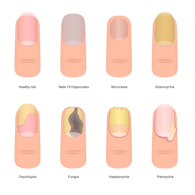 Vector cartoon color nail diseases icon set element problem toenail concept flat design style vector illustration of nails