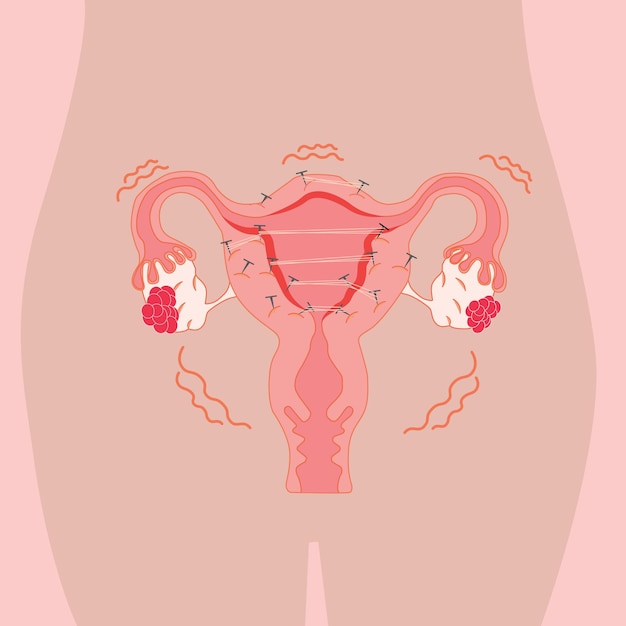 A cartoon illustration of uterus with the uterus in the middle.