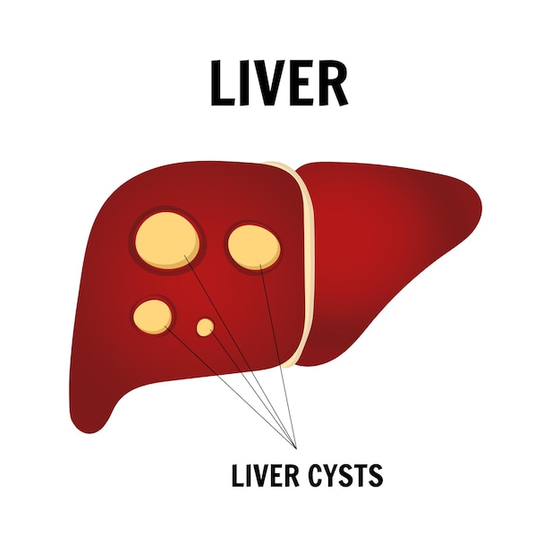 Cartoon liver disease liver cysts in vector illustration