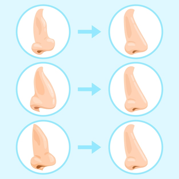 Cartoon rhinoplasty surgery. Rhinoplasty before and after, nose plastic surgery result