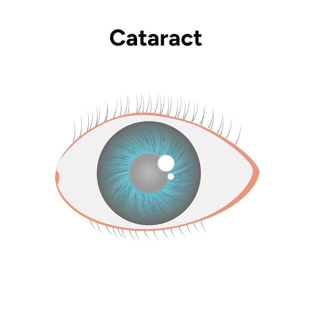 Vector cataract eye disease problem and green eye