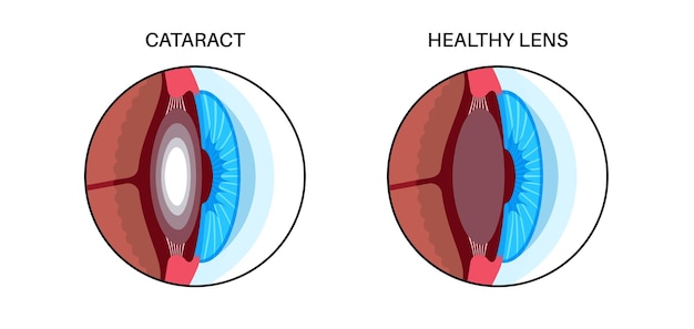 Vector cataract eye disease