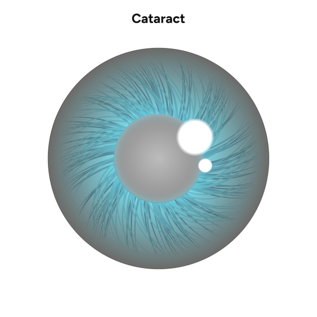 Vector cataract vision disorder problem