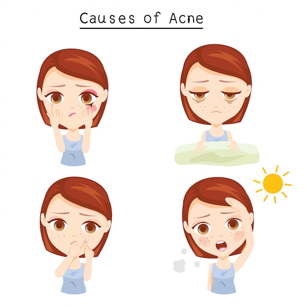 Causes of Acne