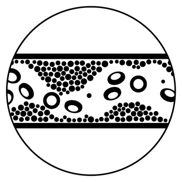 Cholesterol and atherosclerosis