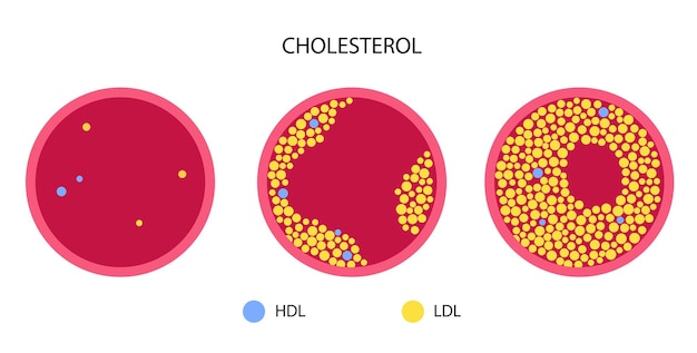 Cholesterol blood artery