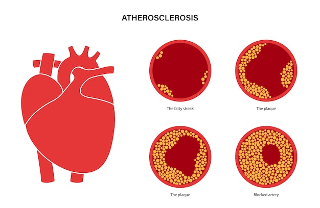 Cholesterol heart disease