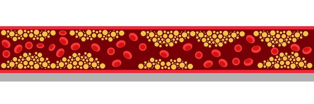 Cholesterol level on blocked blood vessel medical bad hdl lipoprotein