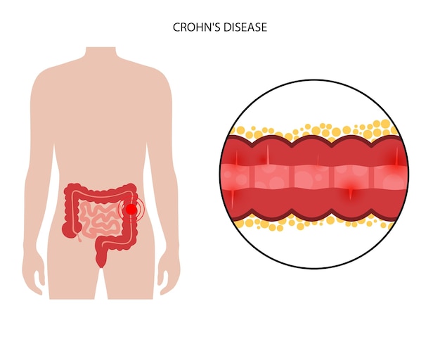 Chrons disease concept