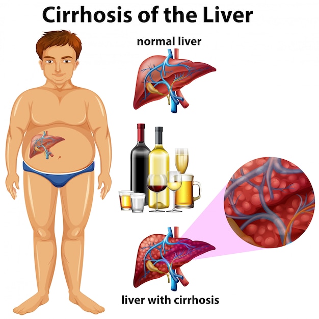 Vector cirrhosis of the liver