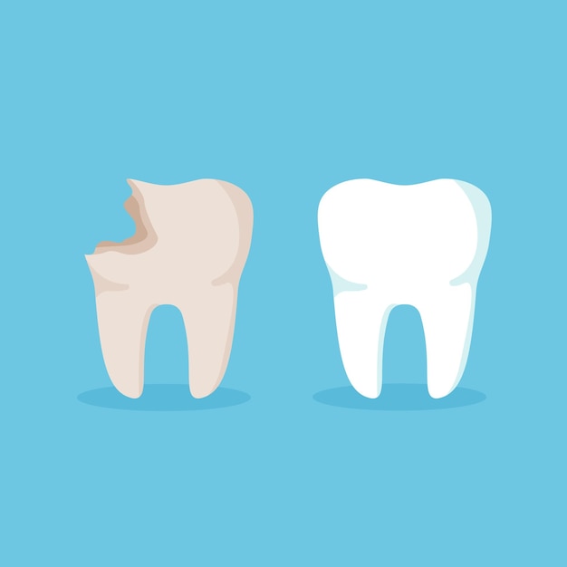 Cleaning teeth. Sick tooth. Before and after caries treatment. Dental health concept. Vector.