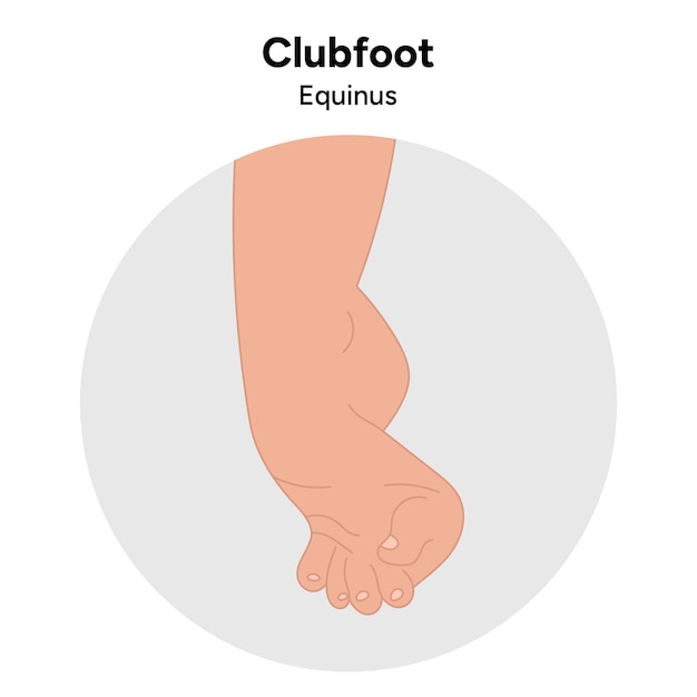 Clubfoot equinus