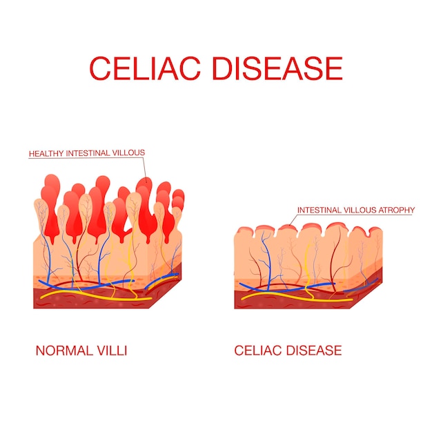 Coeliac disease or celiac diseaseHealthy and damaged villi