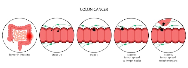 Colon cancer stage