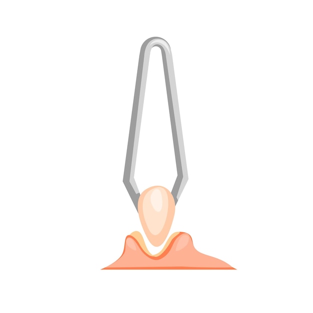 Comedo removal using tweezers illustration vector