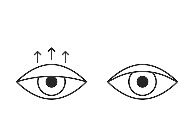 Comparison eye with down lid ptosis and healthy eyelid line icon. Blepharoplasty surgery, correction