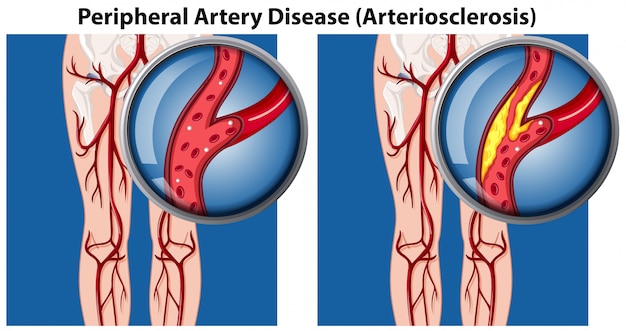 A Comparison of Peripheral Artery Disease