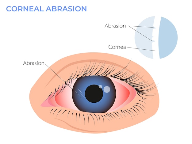 Corneal abrasion illustration Eye redness symptom pink red surfer's eye