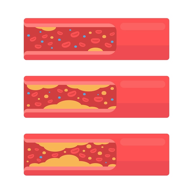 Coronary arteries with accumulated fat in the body