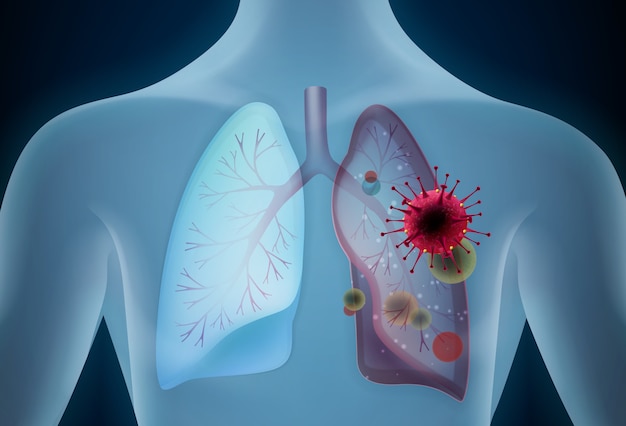 Coronavirus in lungs