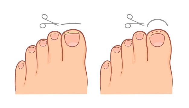 Correct and improper cutting of the toenail medical illustration