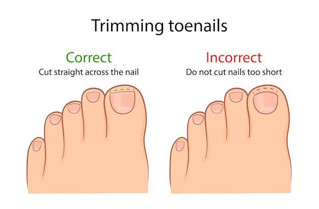 Correct and improper cutting of the toenail medical illustration