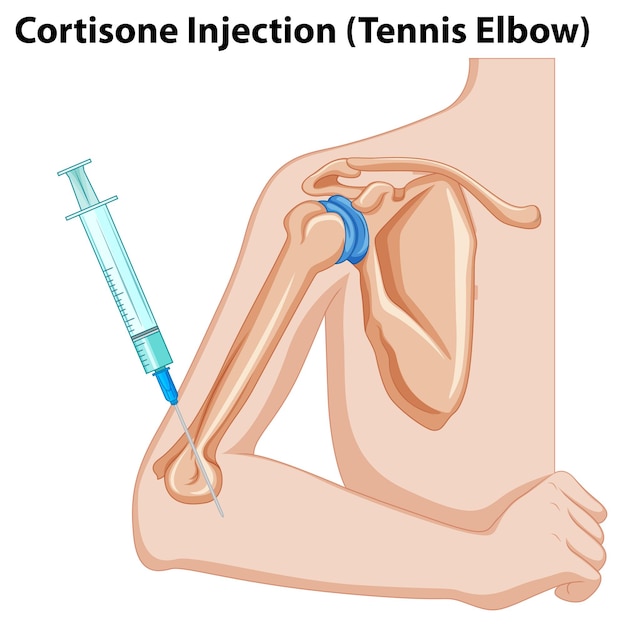 Cortisone Injection Tennis Elbow diagram