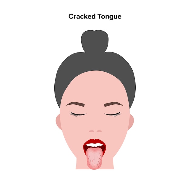 Vector cracked tongue problem in human